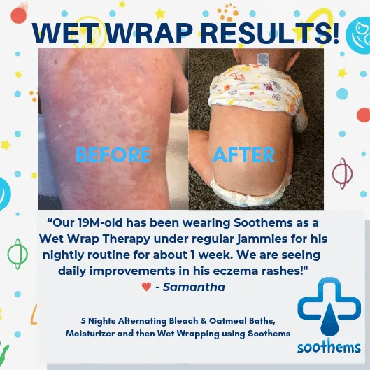 Soothems Eczema Pajamas for Kids - 2 Piece Set for Wet Wrap Therapy and Itch Relief