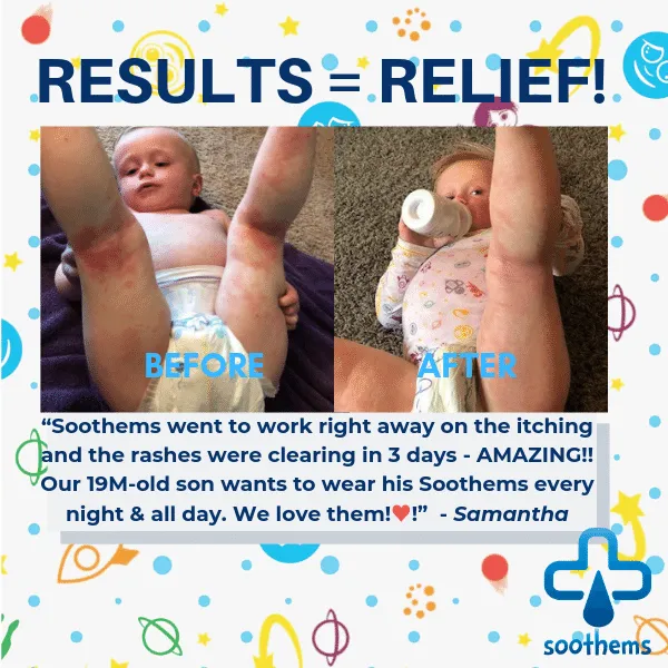 Soothems Eczema Pajamas for Kids - 2 Piece Set for Wet Wrap Therapy and Itch Relief