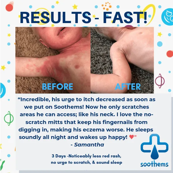 Soothems Eczema Pajamas for Kids - 2 Piece Set for Wet Wrap Therapy and Itch Relief